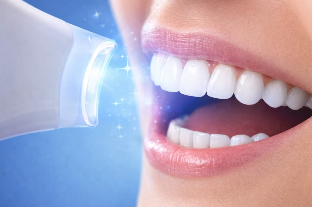 Wybielanie Zębów